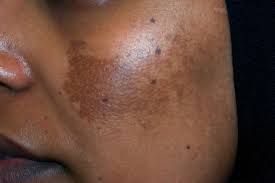 Melasma Pack; Dozi ya Mwezi 1